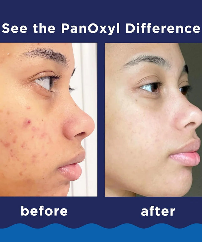 PanOxyl Acne Foaming Wash